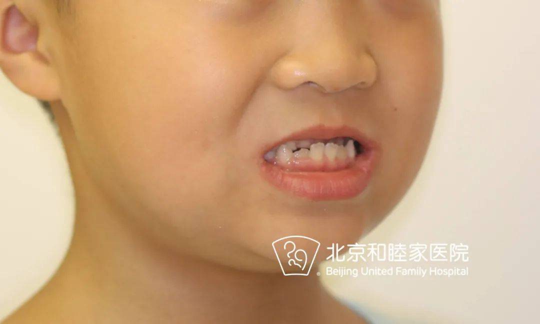 小下巴或者有地包天等问题,笑起来是否牙龈露出过多等 ○ 看牙齿 孩子
