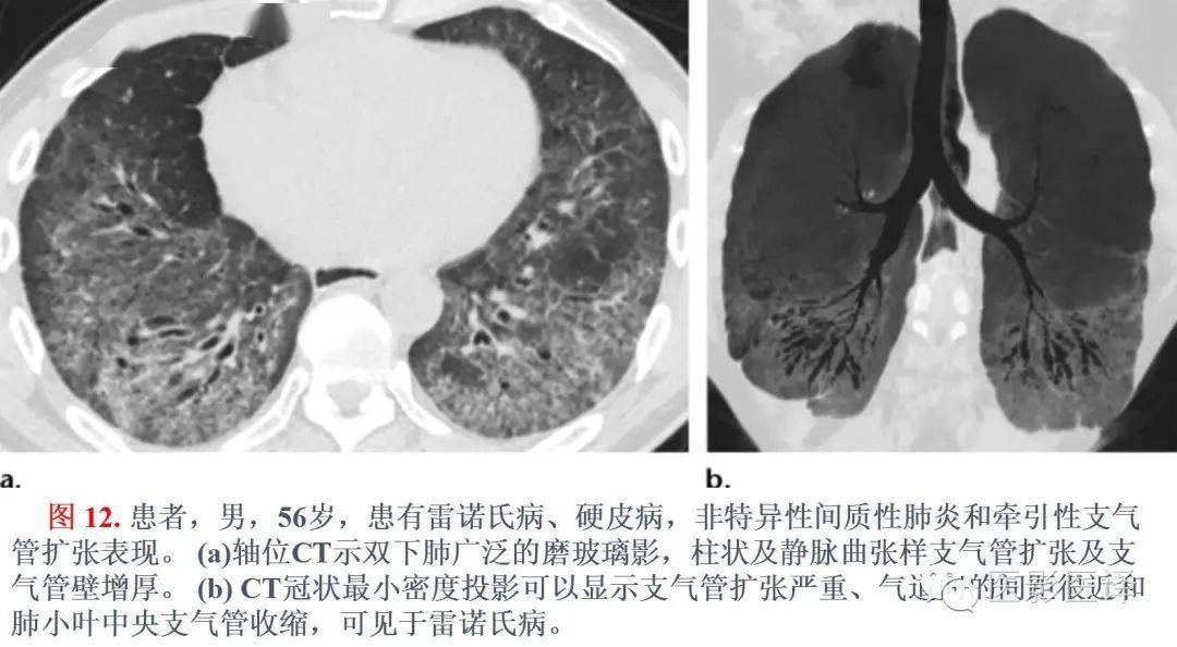 【图文详析】支气管扩张的机制,影像特征和病因