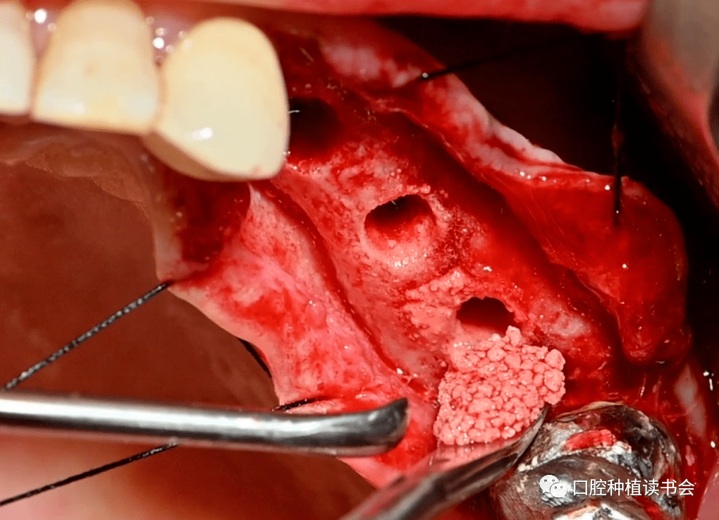 骨再生大赏口服双膦酸盐药物患者上颌窦提升植骨术