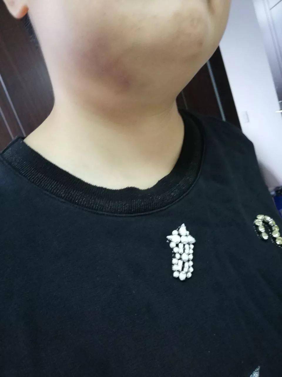 萧山姑娘拔牙遭了大罪,整个过程画面感太强!看完帖子,很多人慌了