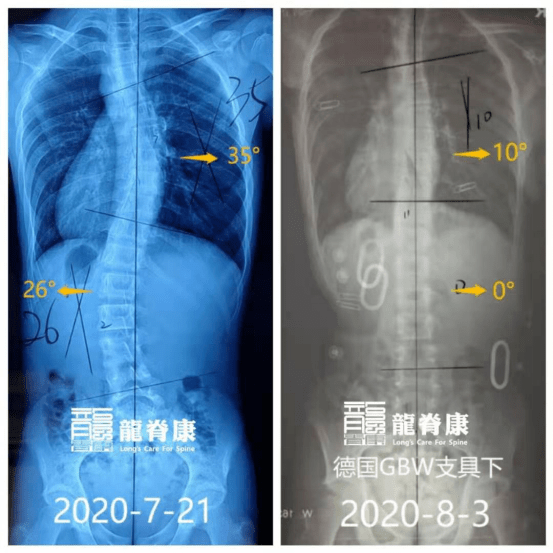 右图是佩戴gbw支具下复查的度数  二, 诊断结果 青少年特发性脊柱侧