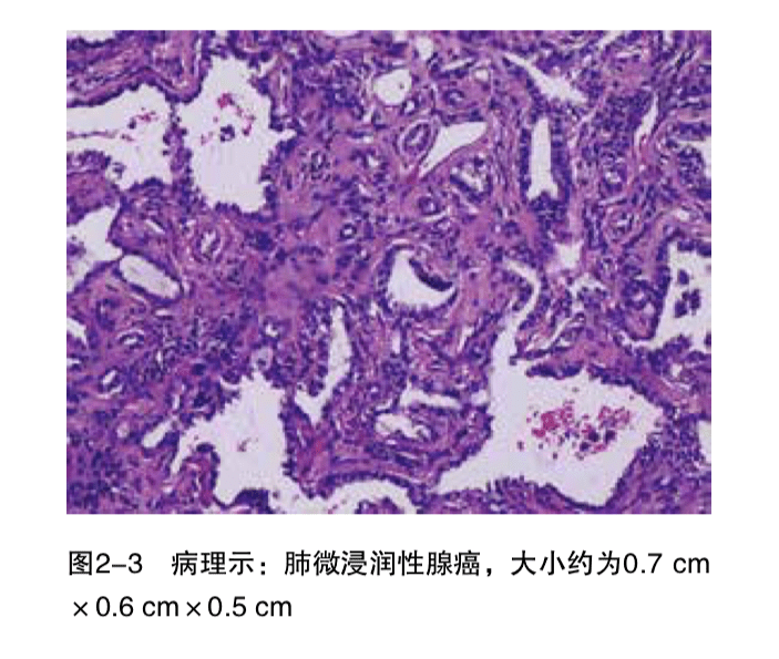 今天走进微浸润性腺癌主题课堂一起学习相关病例肺结节交互印证式诊断