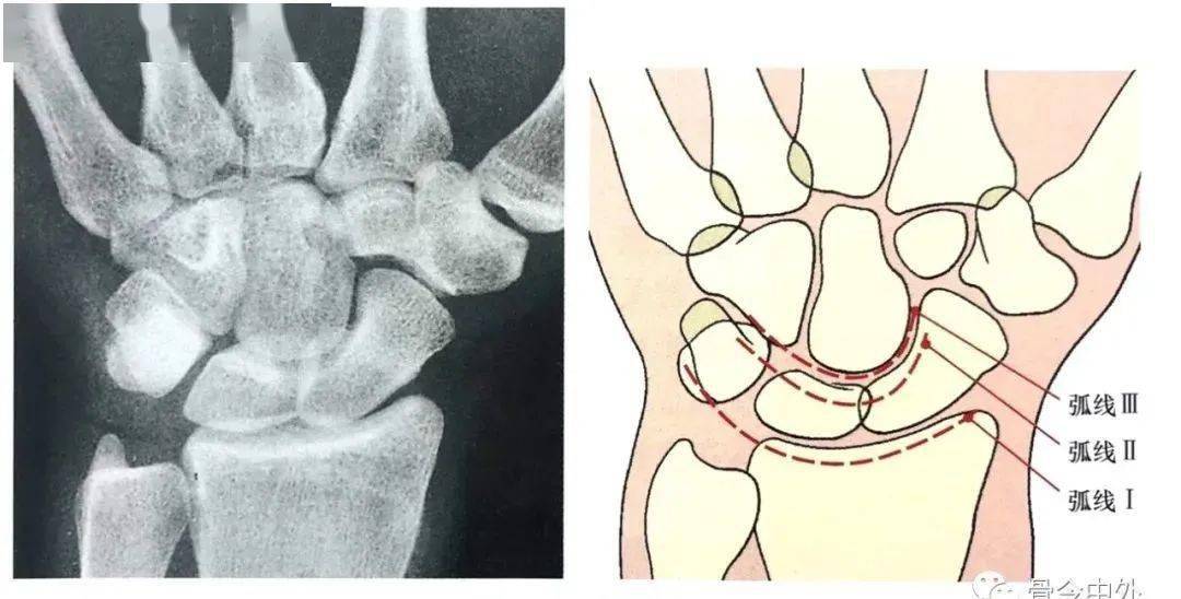 腕关节脱位及其x片阅读技巧