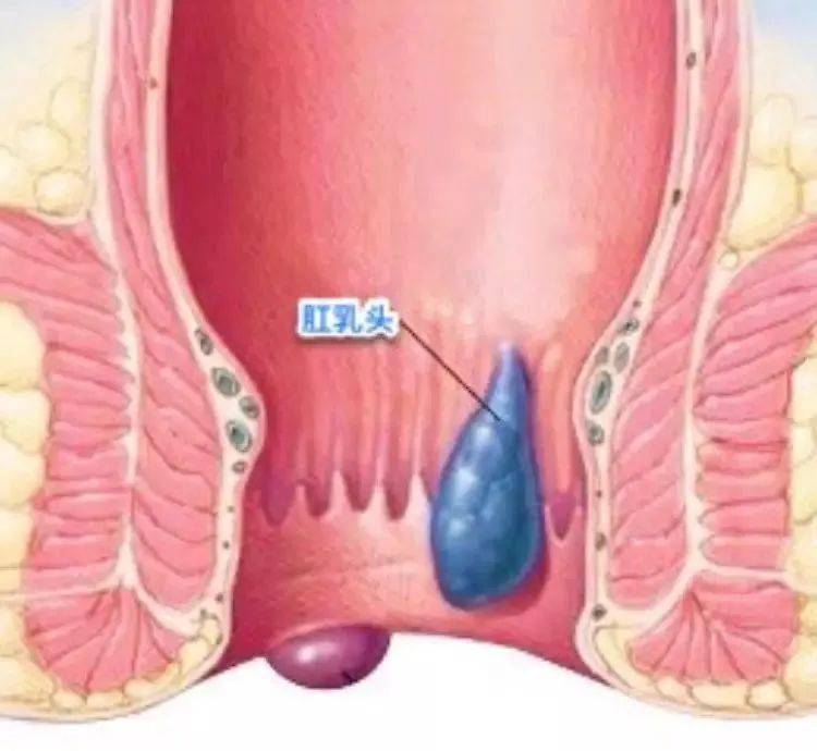 患者提问:  肛门坠胀是痔疮吗?