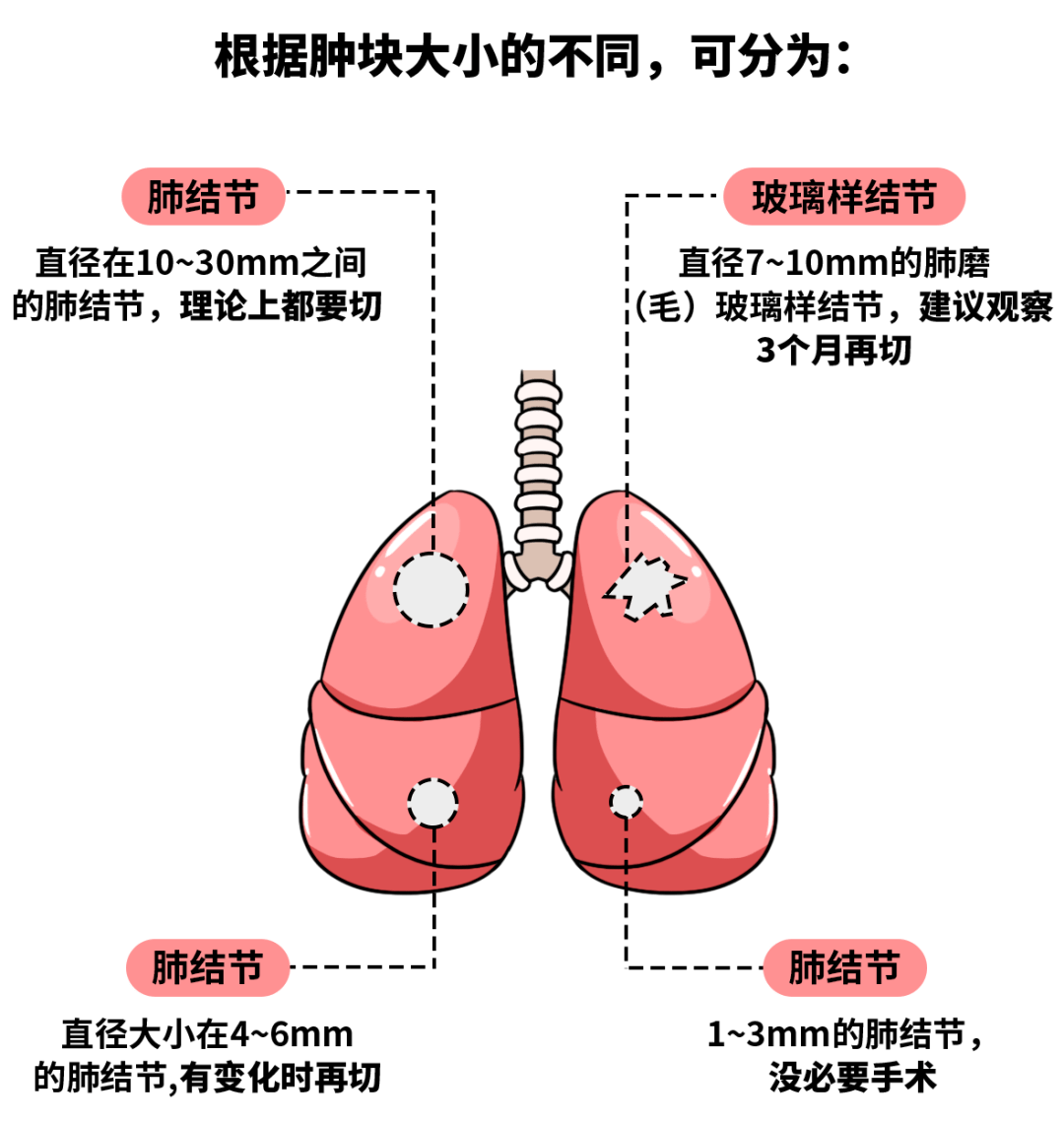 肺结节大小 来自搜狐网