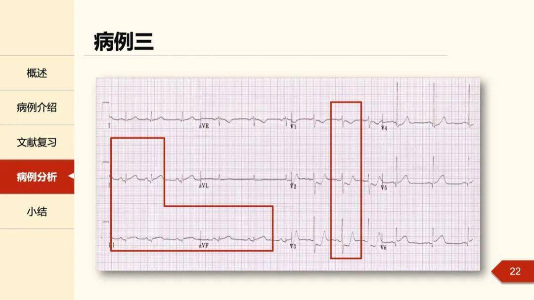 孔令秋教授正后壁心肌梗死的定位困惑及心电图线索