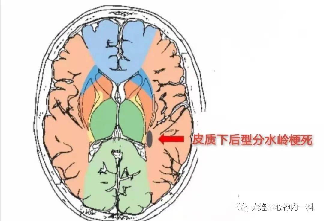 临床必备|缺血性脑卒中临床表现面面观