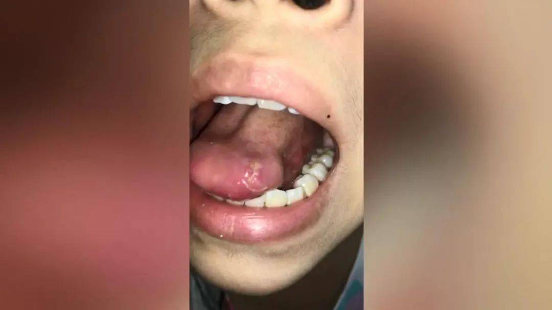 补牙舌头被割破,牙医该赔吗?赔多少?