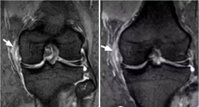 膝关节各种损伤的mri表现大集合_韧带