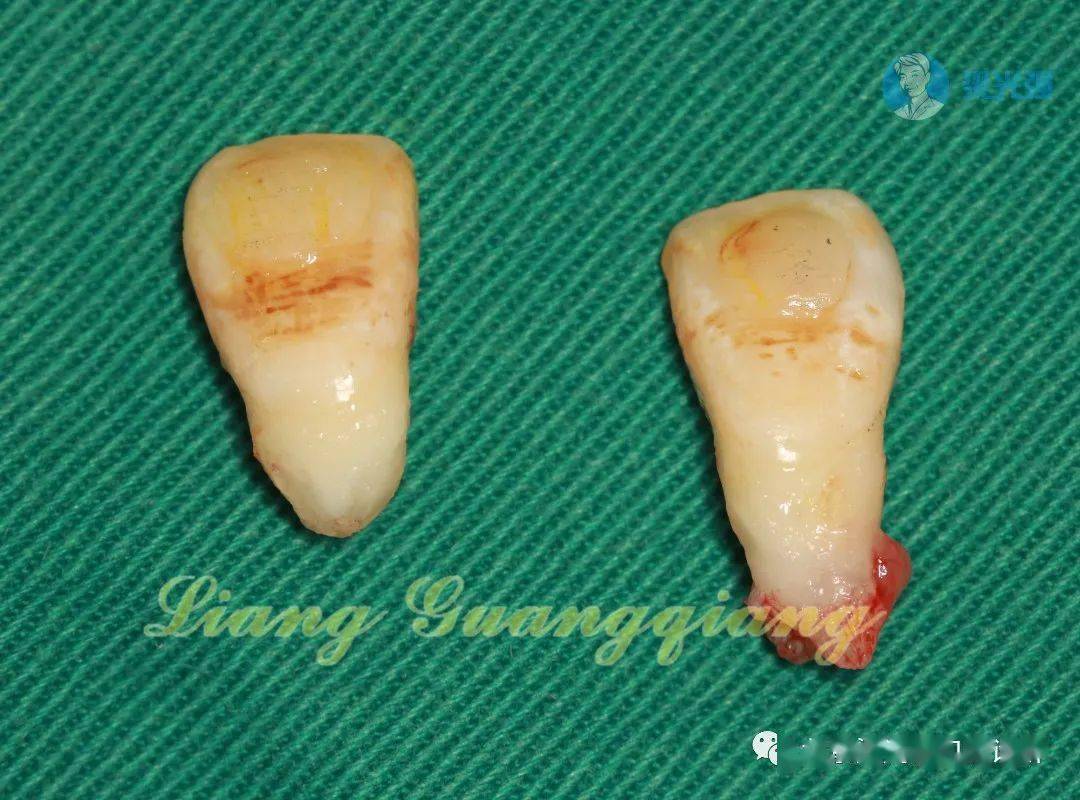 【牙医学堂】前牙即刻种植的另一种临时修复
