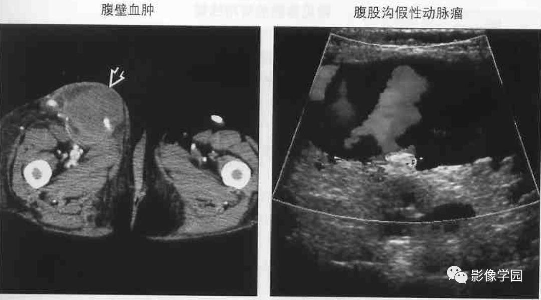 腹股沟区病变的影像鉴别诊断