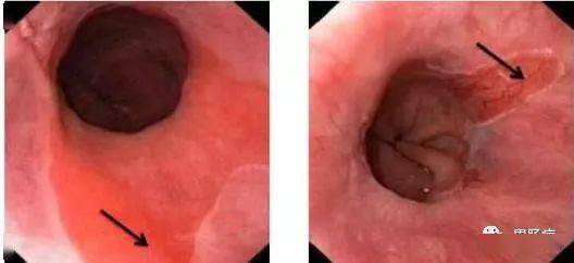 barrett 食管镜下表现