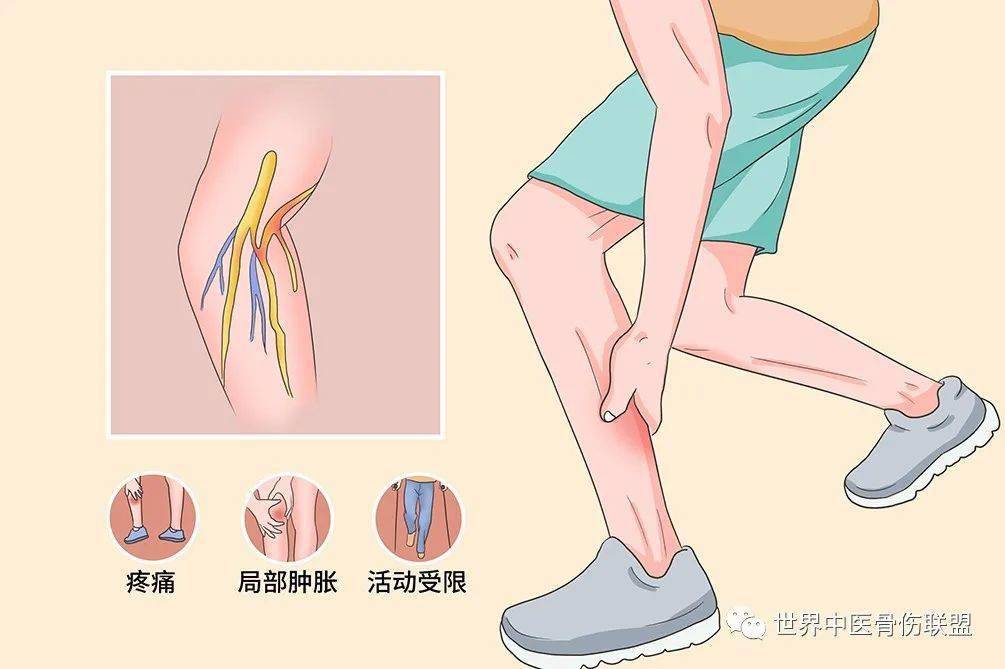 骨筋膜室综合征_手机搜狐网