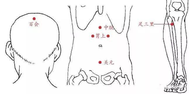 艾灸取穴:百会穴,胃上穴,中脘穴,关元穴,足三里穴中气下陷型胃下垂为