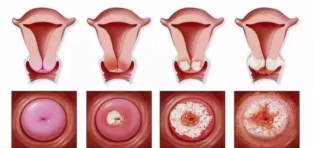 宫颈上皮内瘤变(cin) 宫颈上皮是由宫颈阴道部鳞状上皮与宫颈管柱状