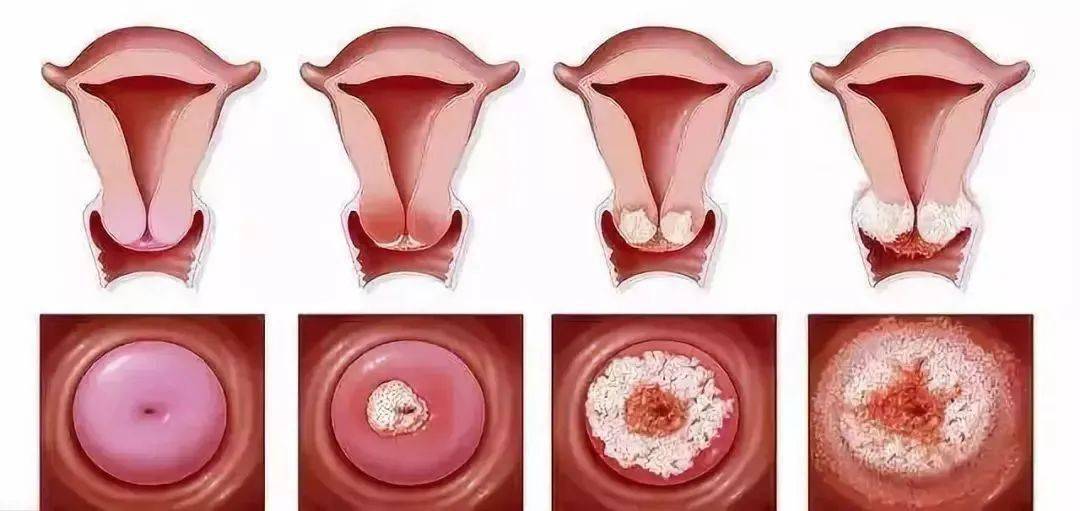 宫颈癌的病因和分型有哪些?