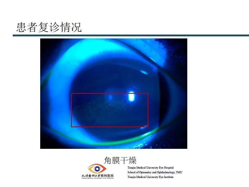 眼视光角膜塑形镜复查异常情况处理病例汇报