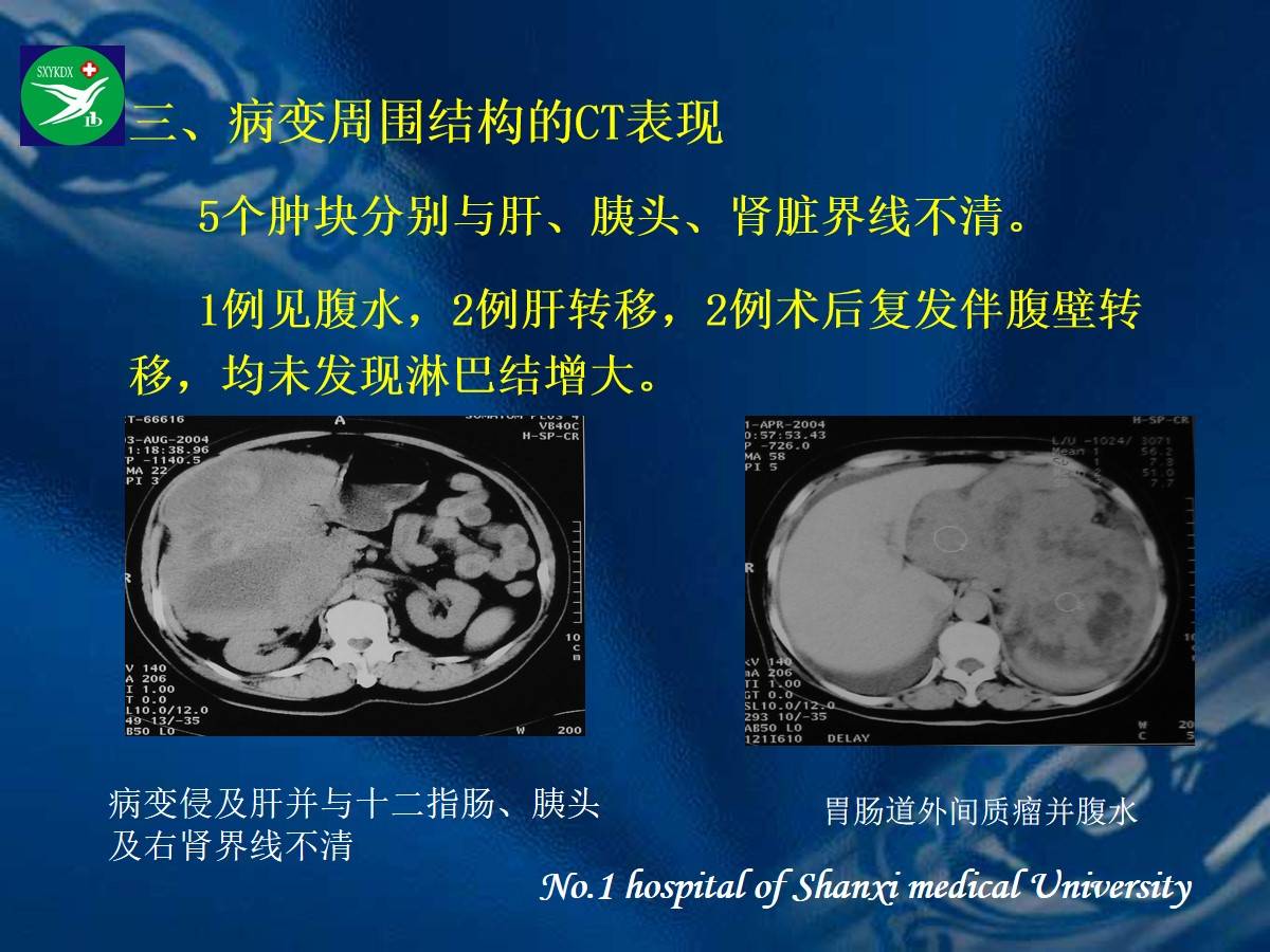 李健丁教授胃肠道外间质瘤的ct表现和临床病理分析