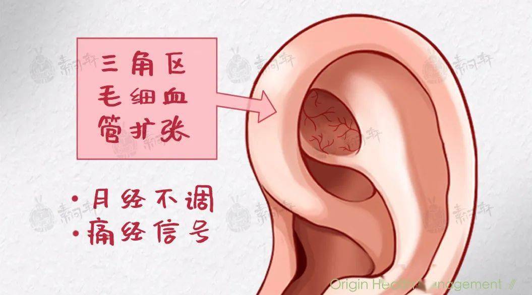 如果耳三角区有小米粒状丘疹,提示有 妇科慢性炎症信号.