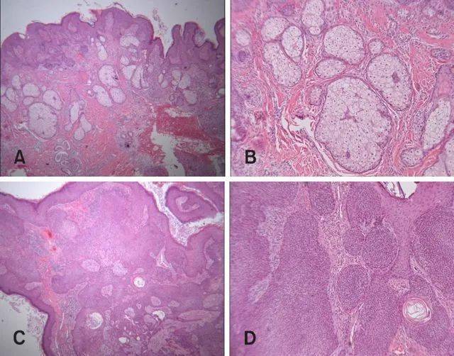 皮脂腺痣继发肿瘤,这次是什么?