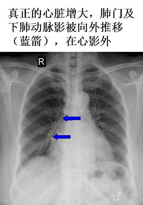 真正的心脏增大,肺门及下肺动脉影被向外推移(蓝箭头),在心影外