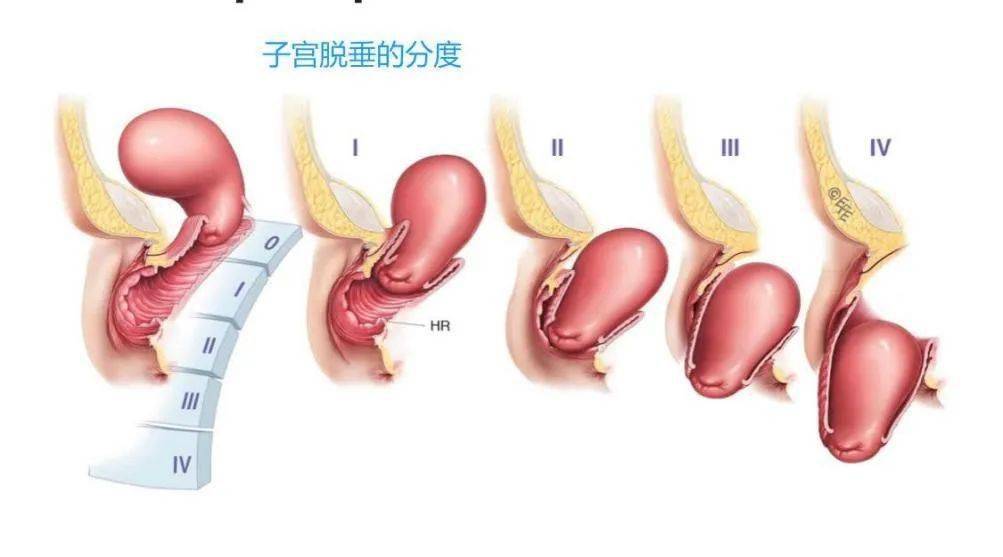 老年人子宫脱垂怎么办