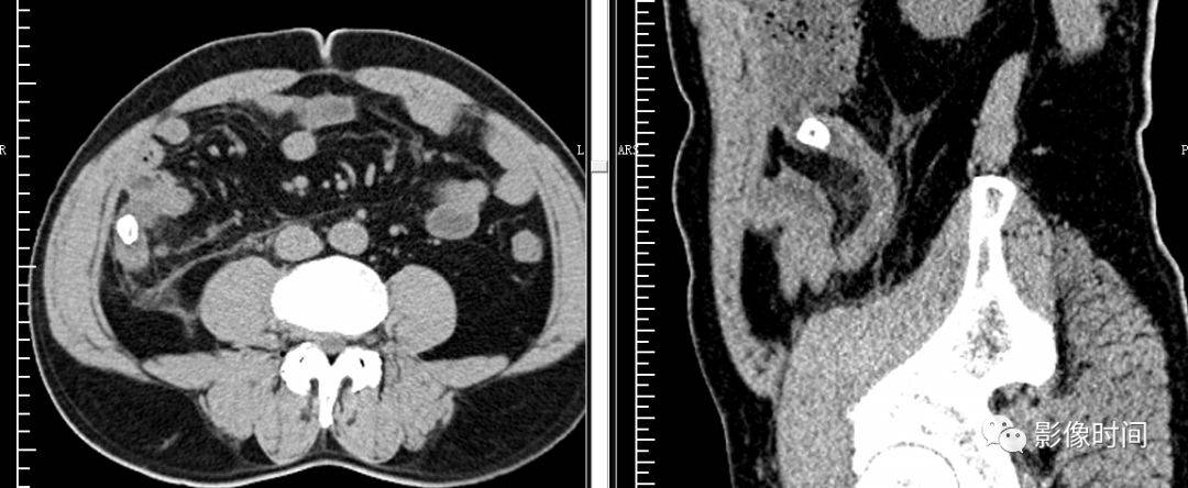 阑尾增粗,肿胀,阑尾口见粪石,周围脂肪间隙模糊,见索条影,曲面重建可