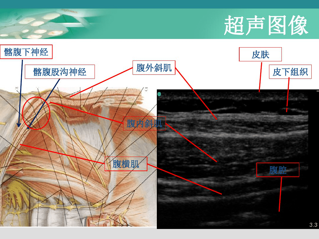 徐医附院麻醉科超声引导下腹横肌平面神经阻滞tap