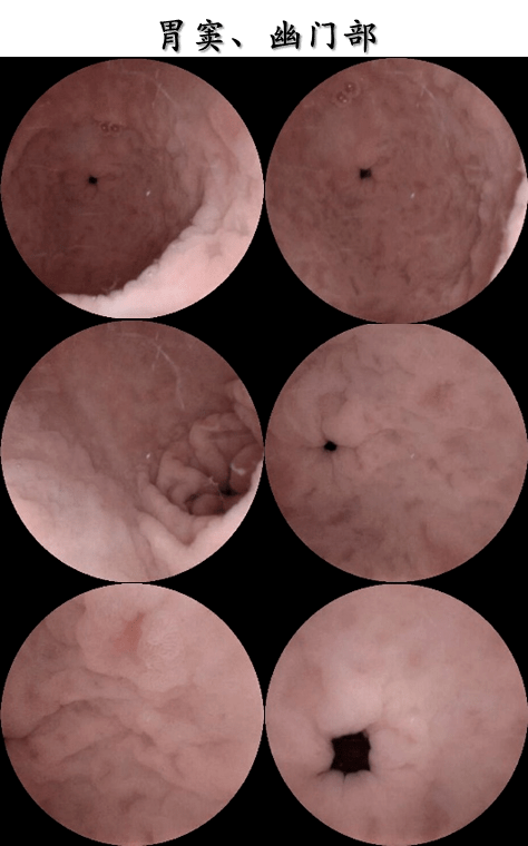 "智无止镜"首届磁控胶囊胃镜图像大赛总决赛一等奖病例_食管