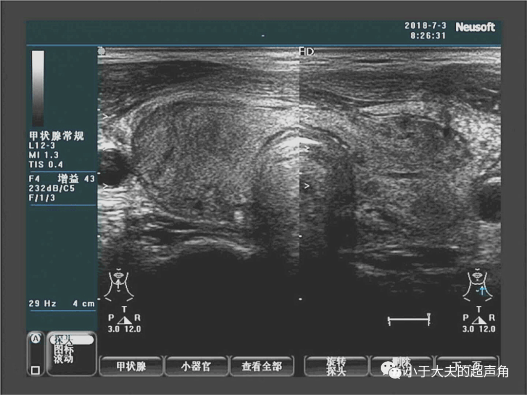 【超声随响】第48期 急性甲状腺炎 甲腺铜墙幸无漏,梨