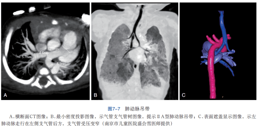 【干货】秒懂 ct血管成像检查和诊断要点:急性肺动脉栓塞