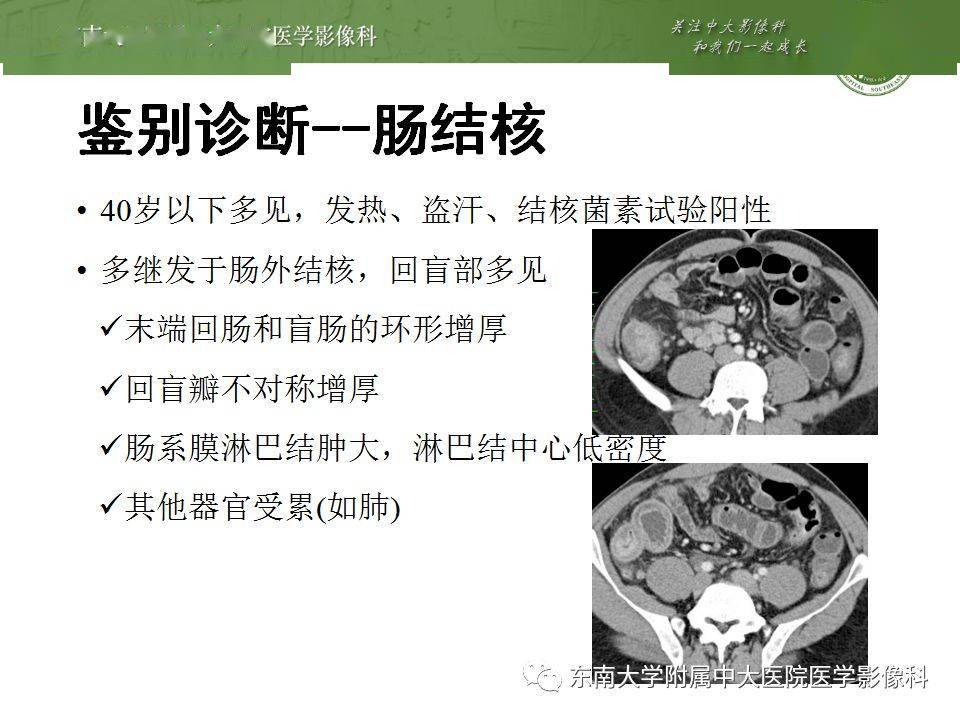 肠管丨右半结肠克罗恩病