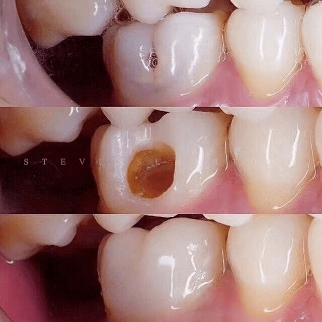 为什么有时牙齿表面只有一个小洞却需要根管治疗