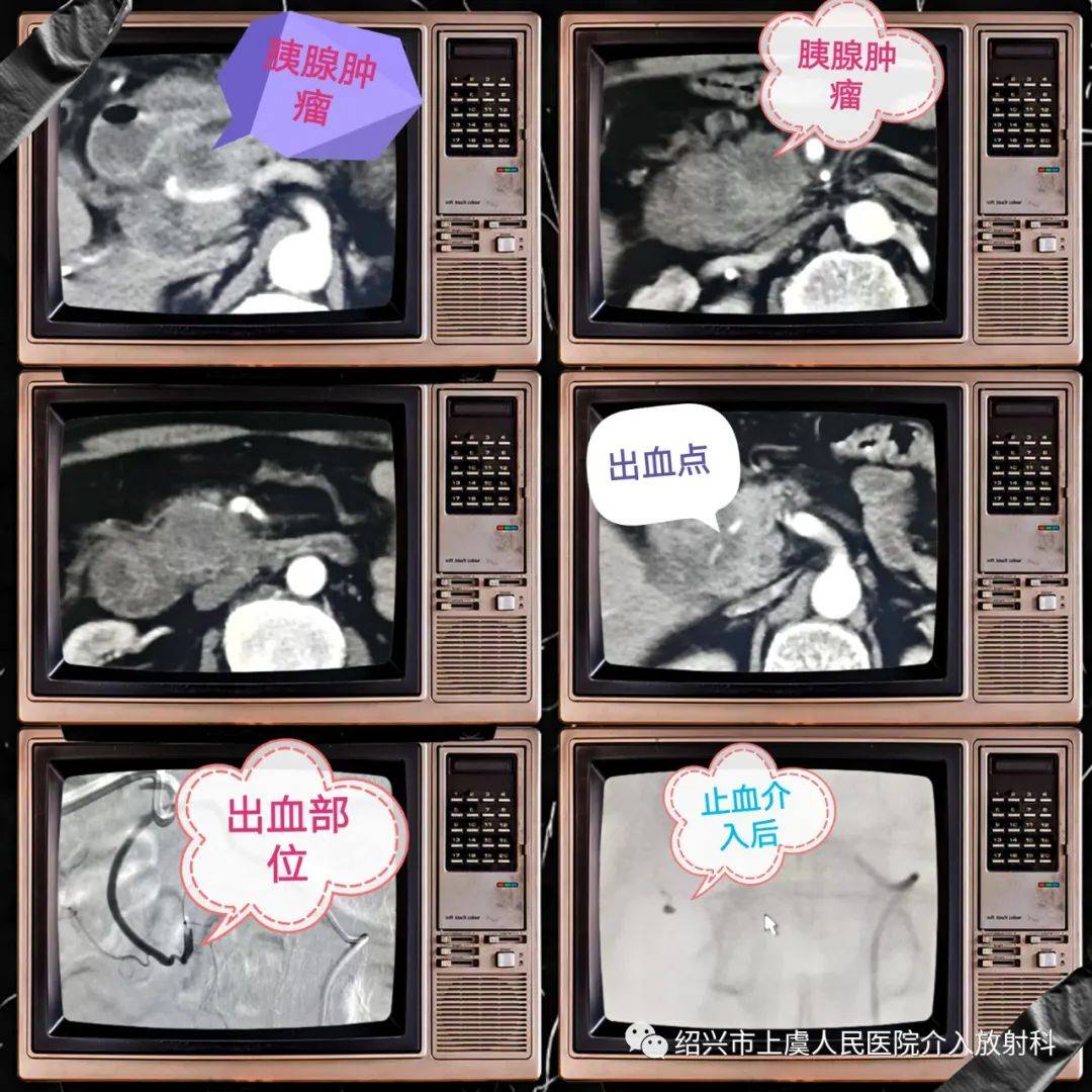 患者男,69岁,主诉:胰头部肿瘤数年,住院放疗后大出血,有呕血,量大