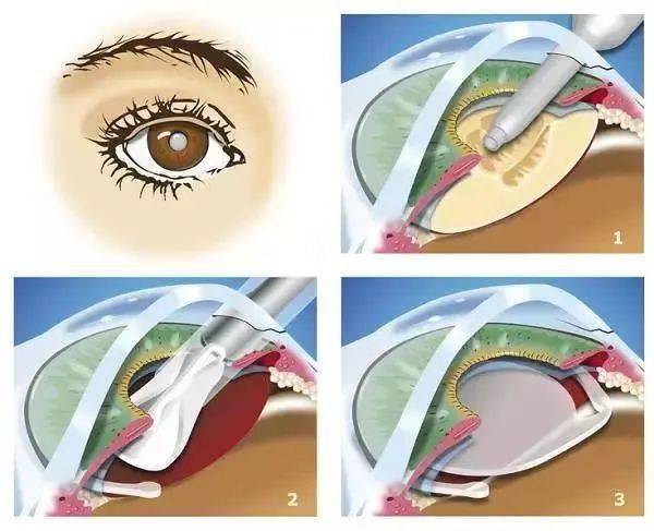 白内障最有效的方法,临床常用的是超声乳化晶体吸除联合人工晶体植入