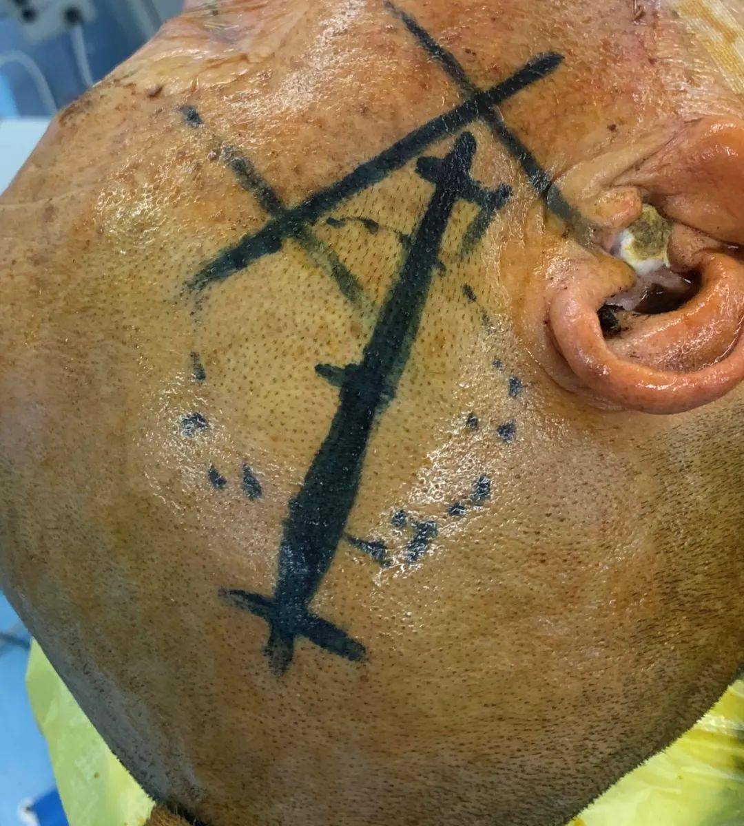 脑出血的各种治疗措施,尤其是在小骨窗开颅血肿清除术上有很高的造诣
