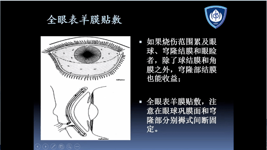 穹隆部结膜也能收益;全眼表羊膜贴敷,注意在眼球巩膜面和穹隆部分别褥