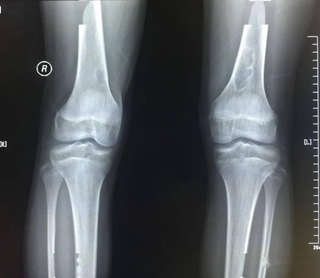 双股骨远端病变——非骨化性纤维瘤