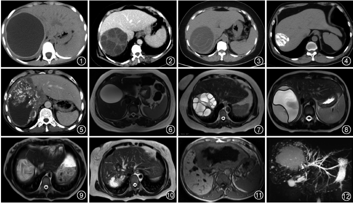 图2为ce2型,ct增强静脉期显示多子囊型包虫囊肿呈"囊内囊"轮辐征.