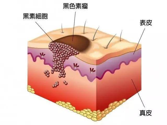 肿瘤科普皮肤黑色素瘤简单有效的abcde识别法