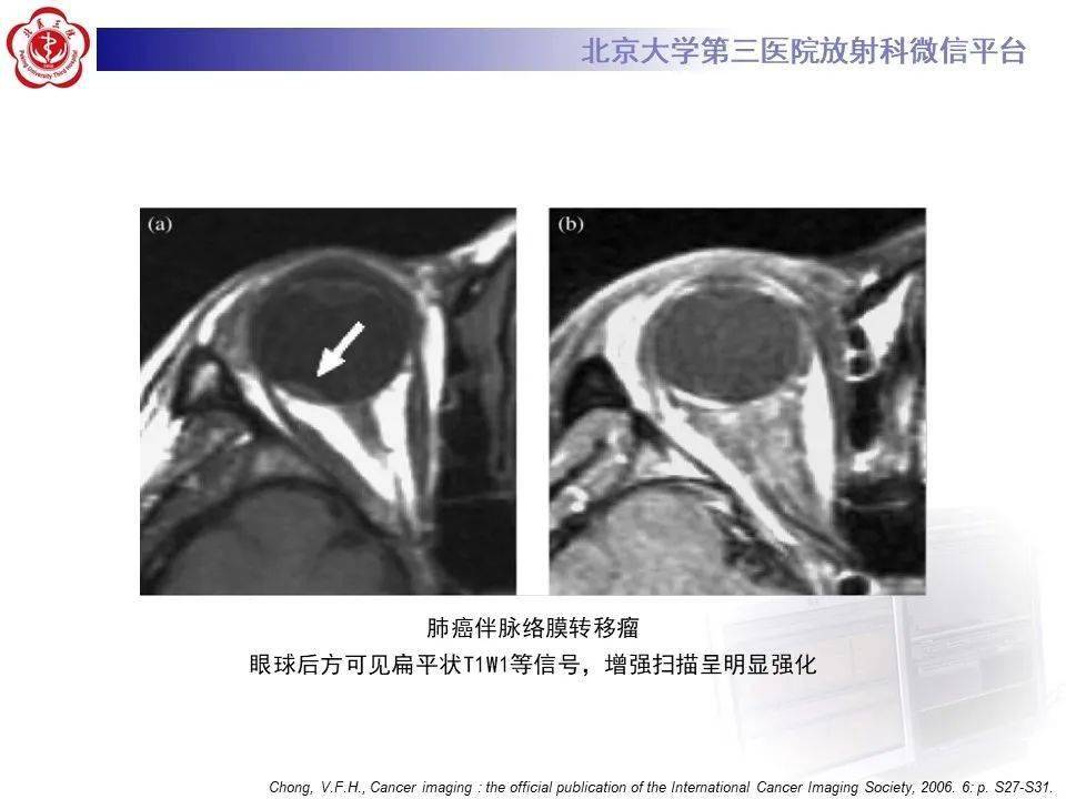 北医三院放射科病例723—神经五官
