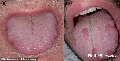 新冠病毒或致患者出现"新冠舌头"症状