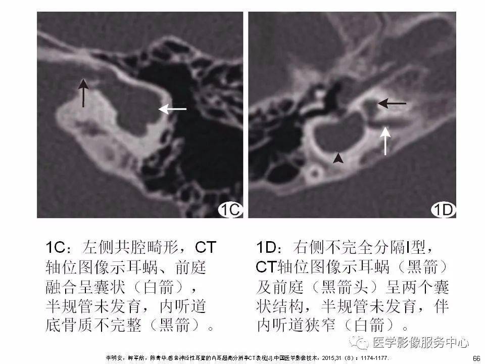 本文目录 第一部分:耳蜗解剖 第二部分:内耳畸形分类,主要基于ct 第