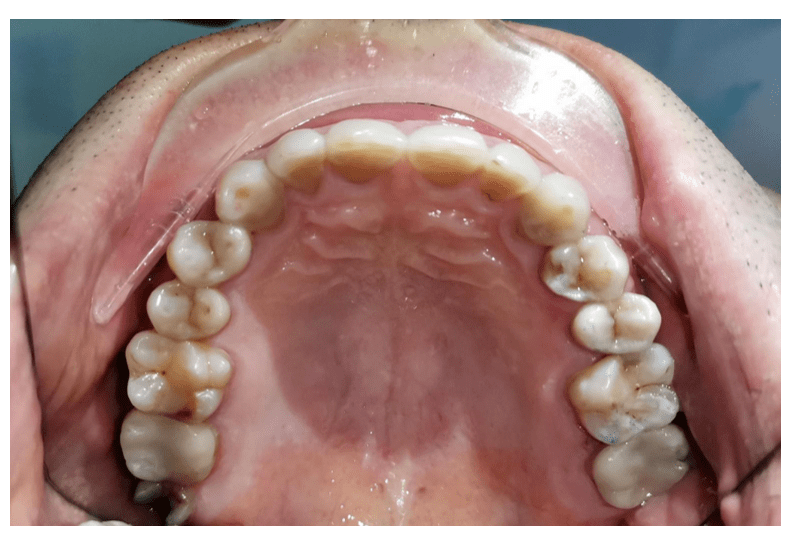 【病例】上颌第二恒磨牙大面积磨耗emax瓷嵌体微创修复