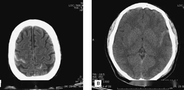 简明又详细的头部ct读片详解!_脑室