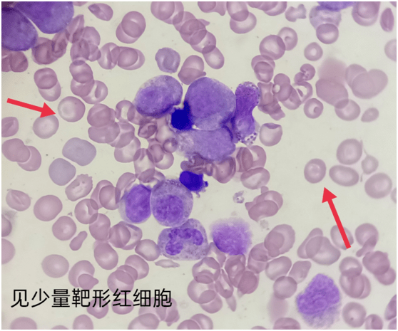 小小血涂片,发现大问题_红细胞