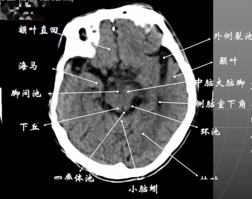 其前角连于纵裂池,两外侧角连于外侧裂池,两后外侧角延续于环池,第六