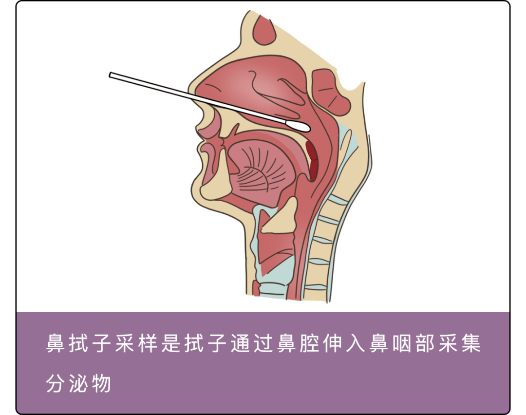 戳鼻子,插喉咙,捅菊花目前普遍的核酸检测采样方法有三种和新冠病毒