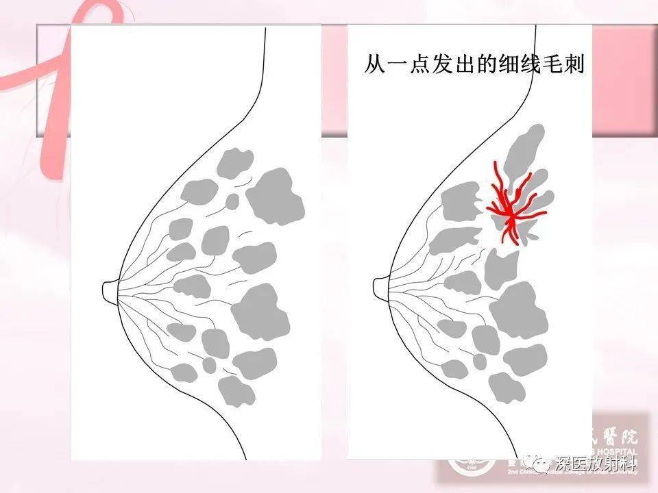 乳腺影像学征象解析_放射科