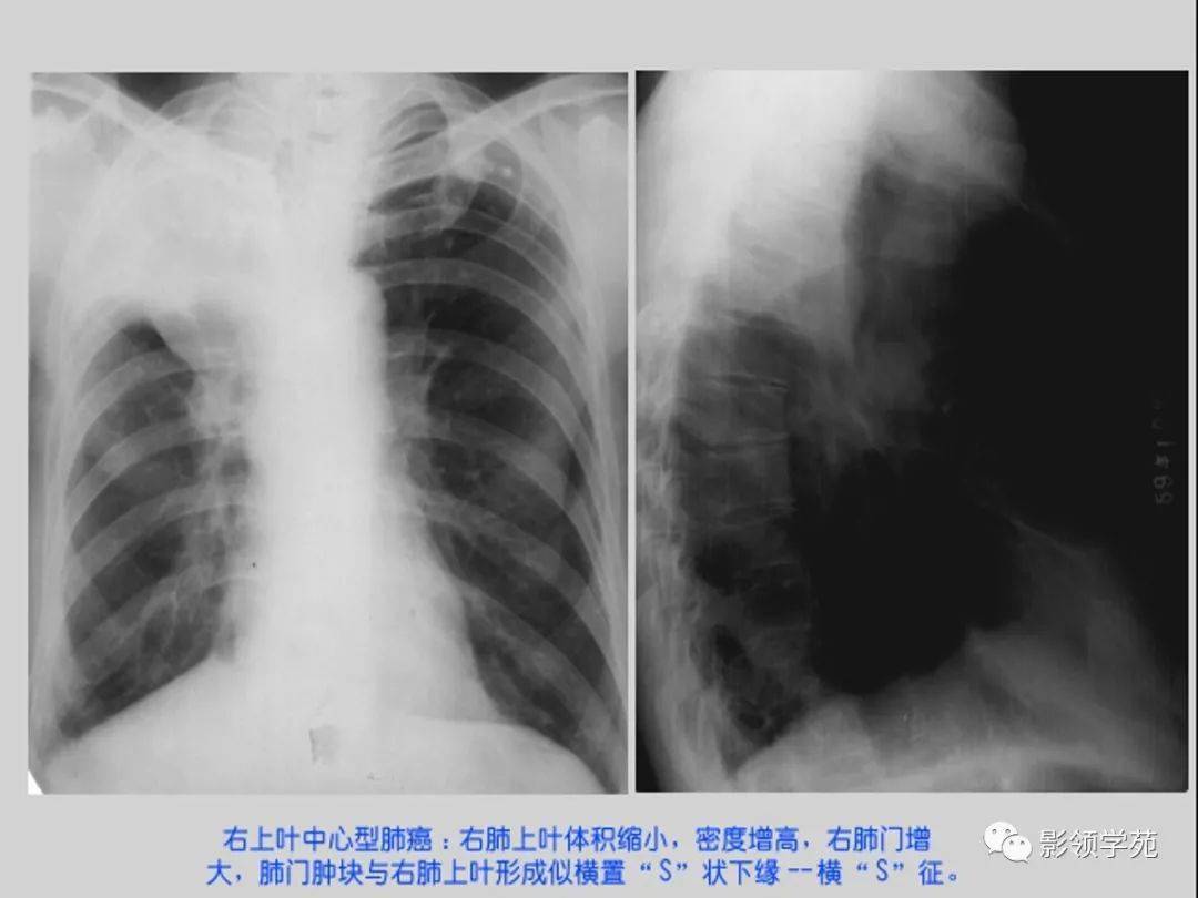 肺部常见疾病的影像诊断
